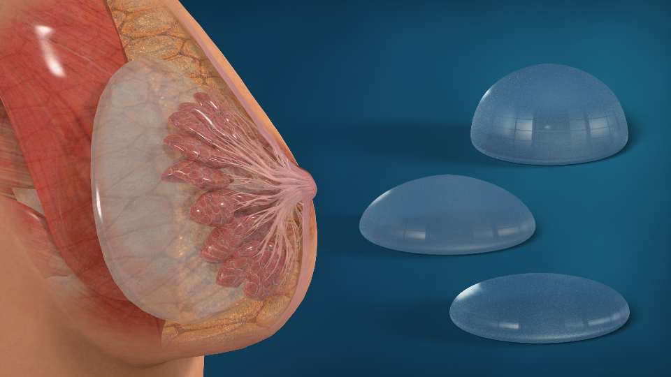 Austin Breast Augmentation