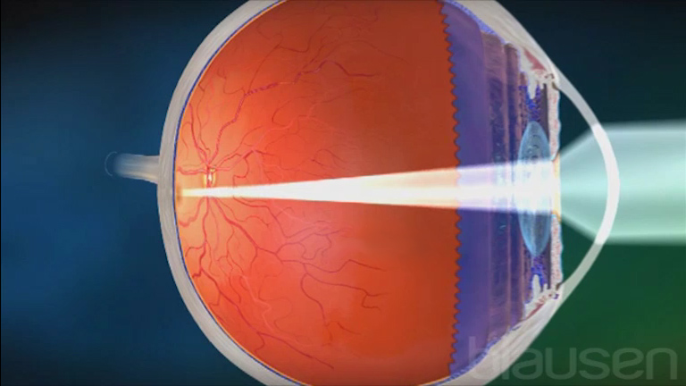Near Far Sightedness Understand Com
