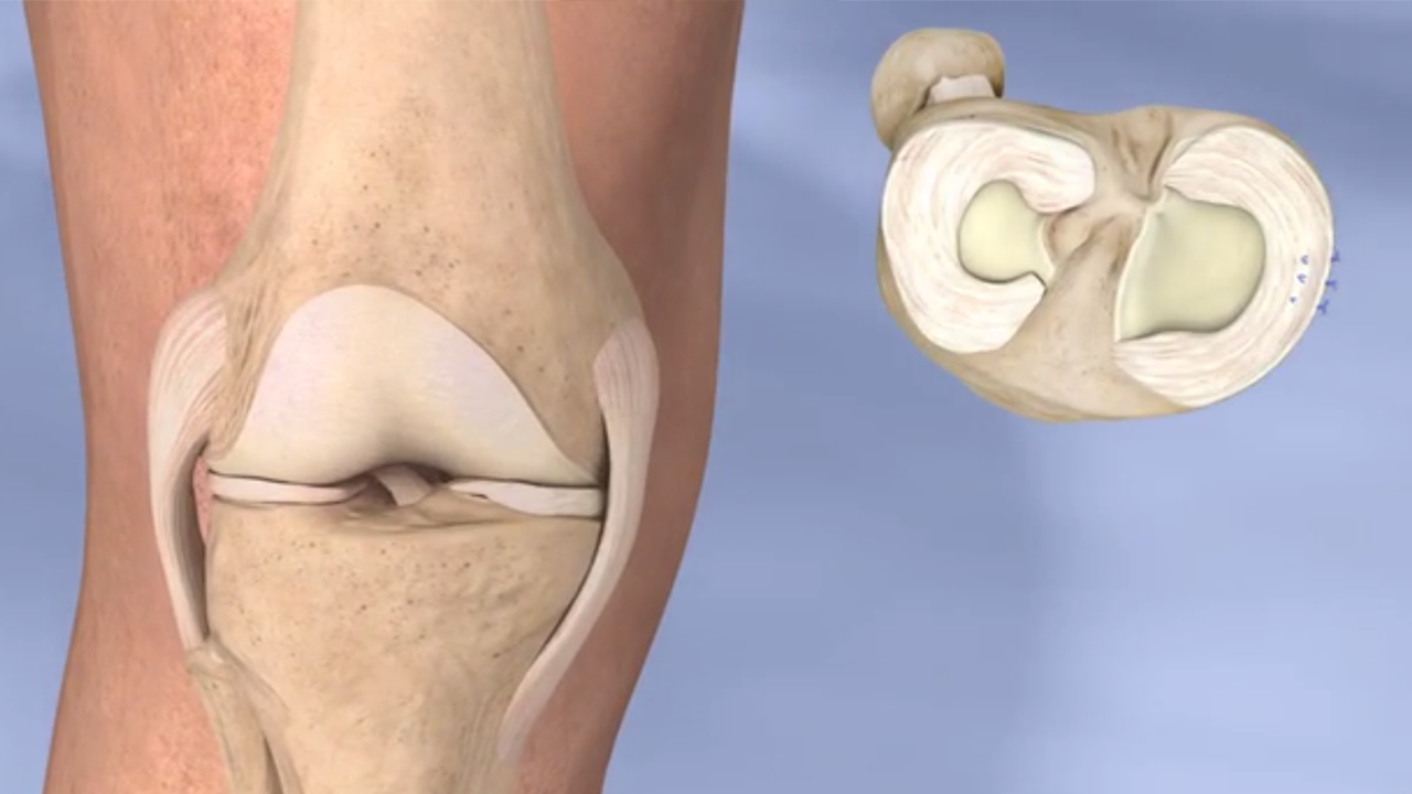 Torn Meniscus Uw Orthopaedics And Sports Medicine Seattle